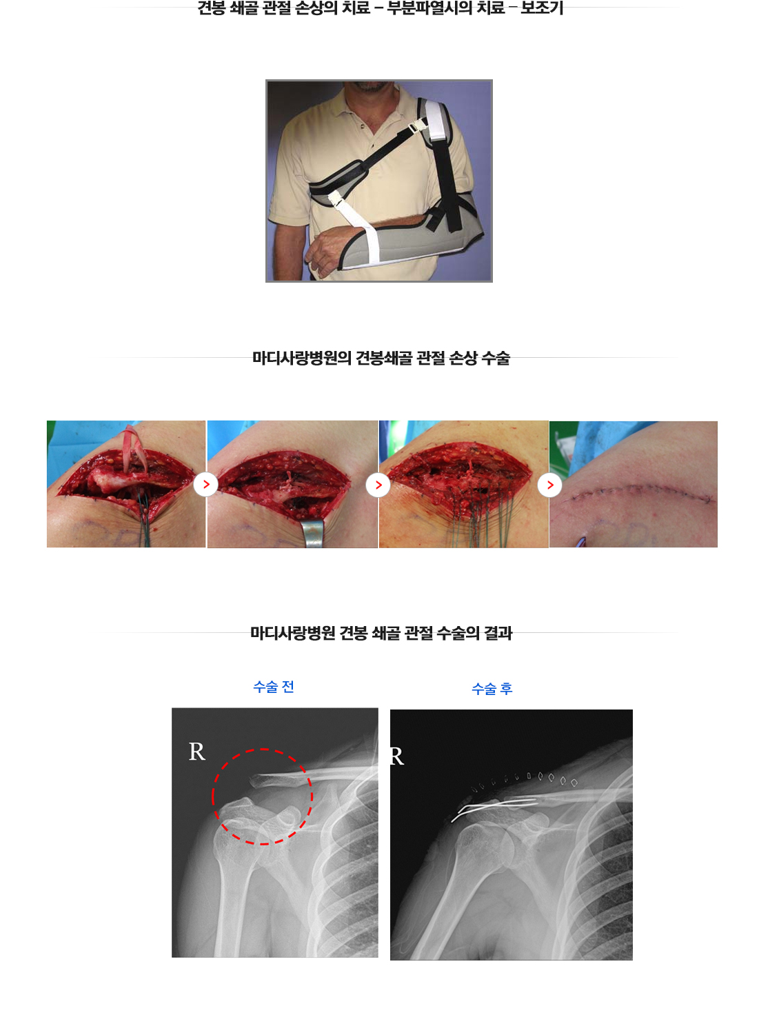 어깨 관절 골절