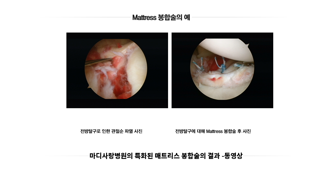 외상성 탈구