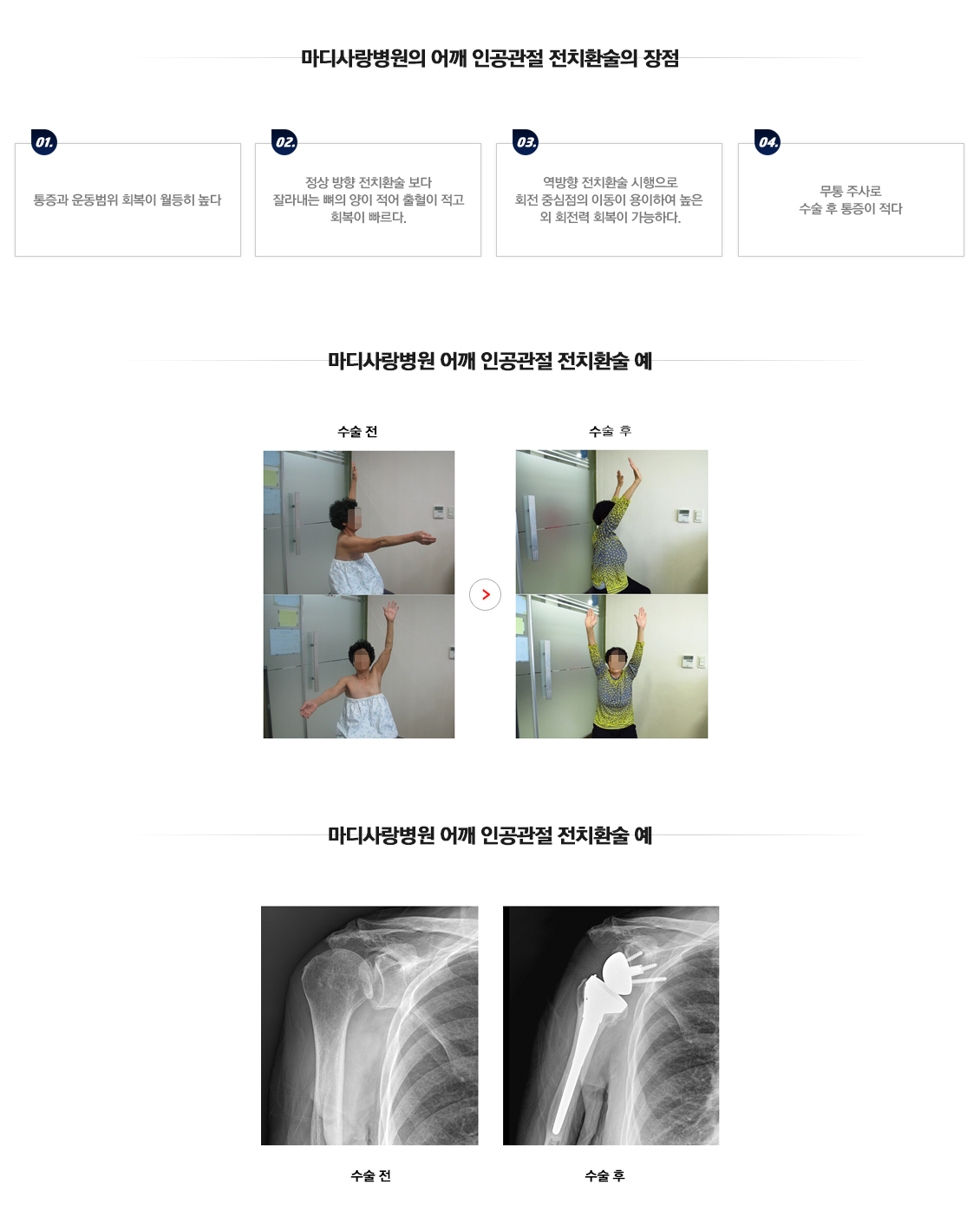 어깨 인공관절 부분치환술