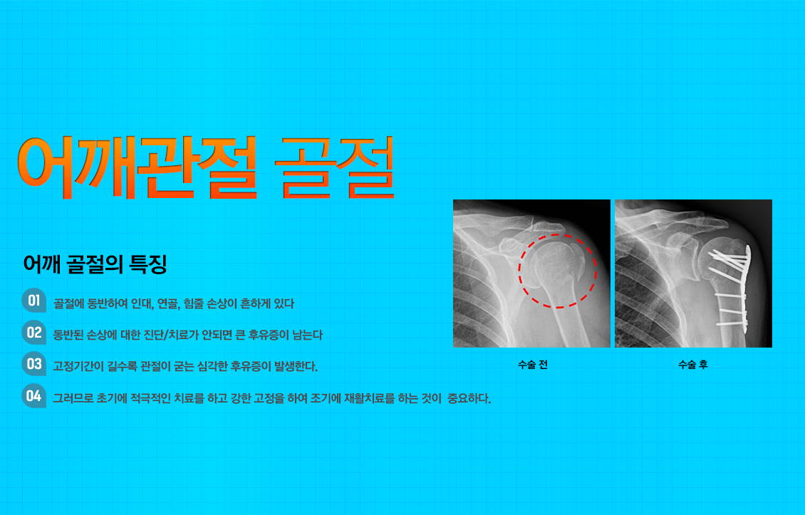 어깨 골절수술