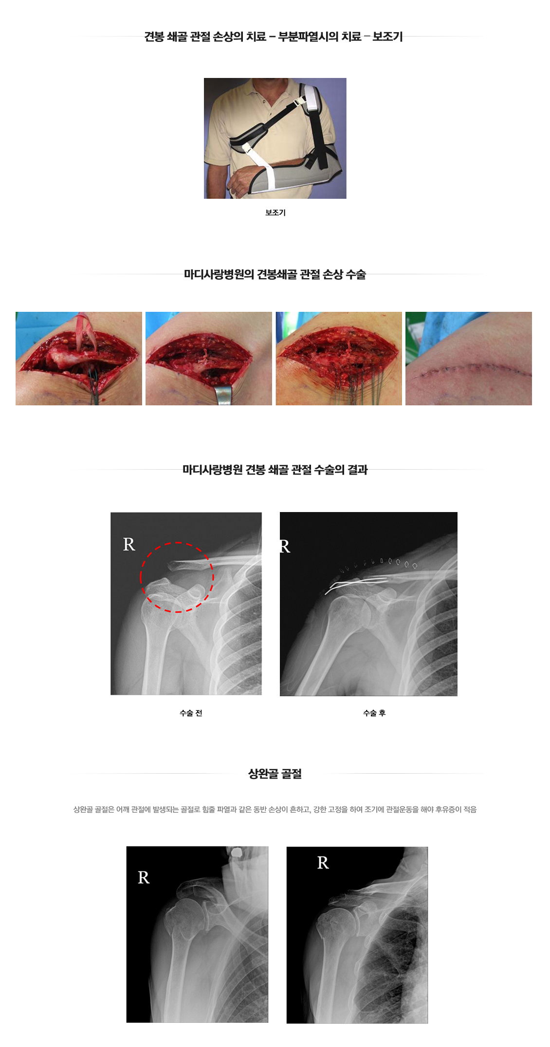 어깨 골절수술