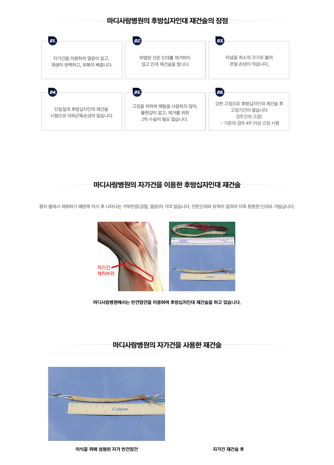 후방십자인대 재건술