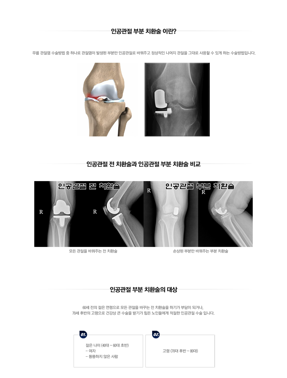 인공관절 부분치환술