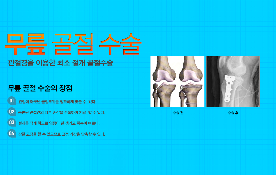무릎 골절수술