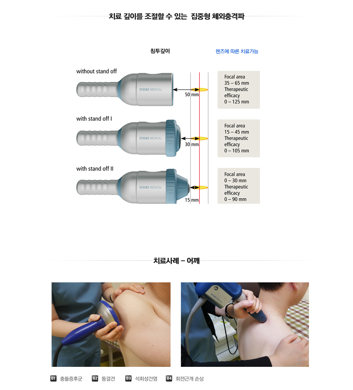 체외충격파(ESWT)