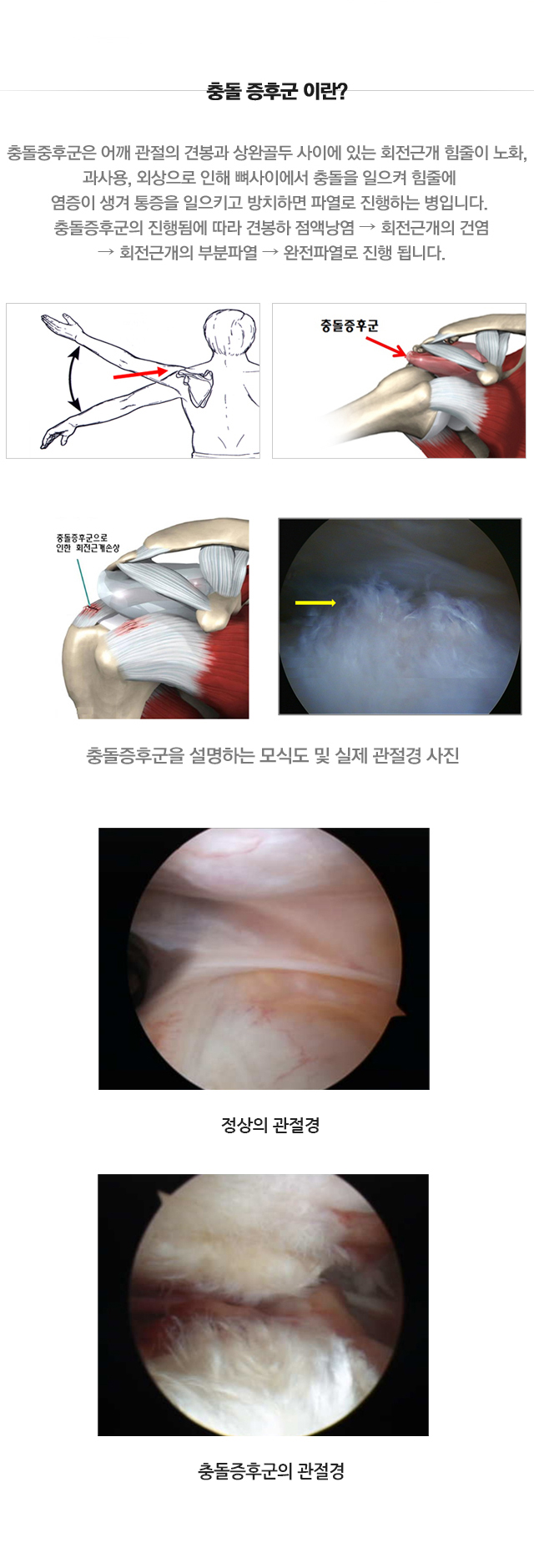 충돌증후군