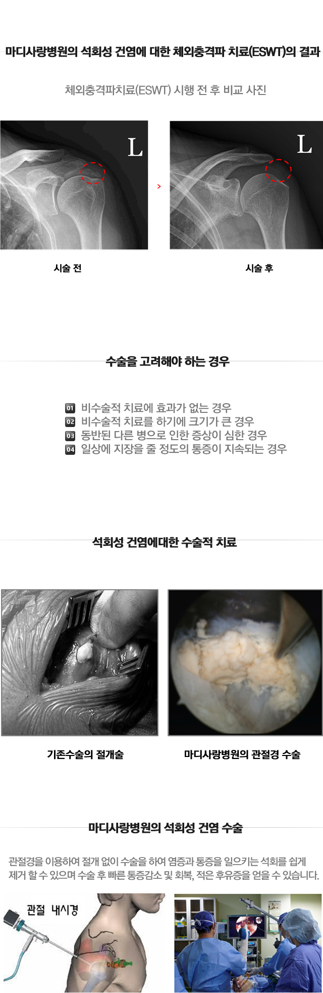 석회성건염