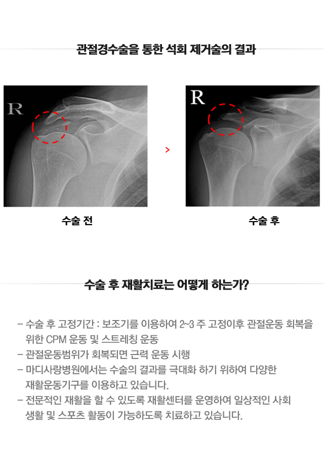 석회성건염