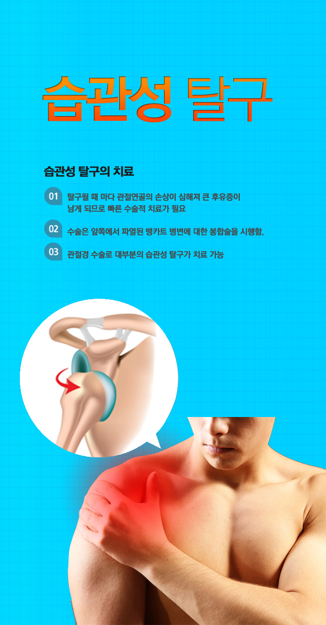 습관성 탈구