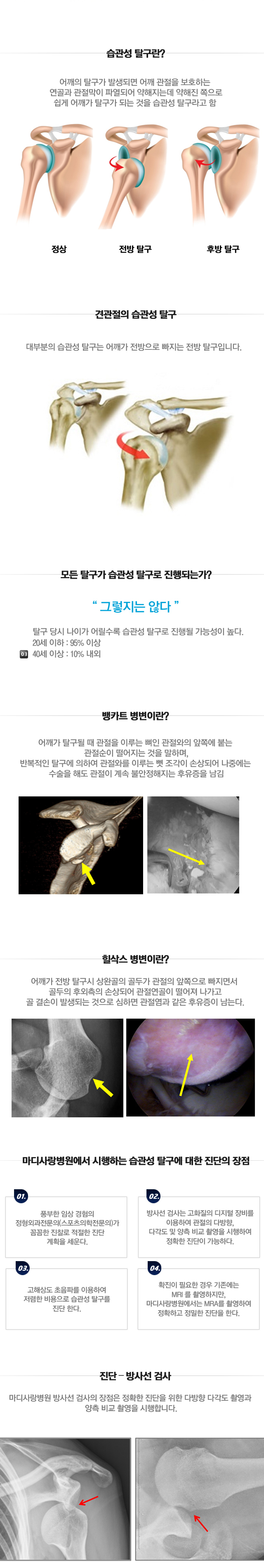 습관성 탈구