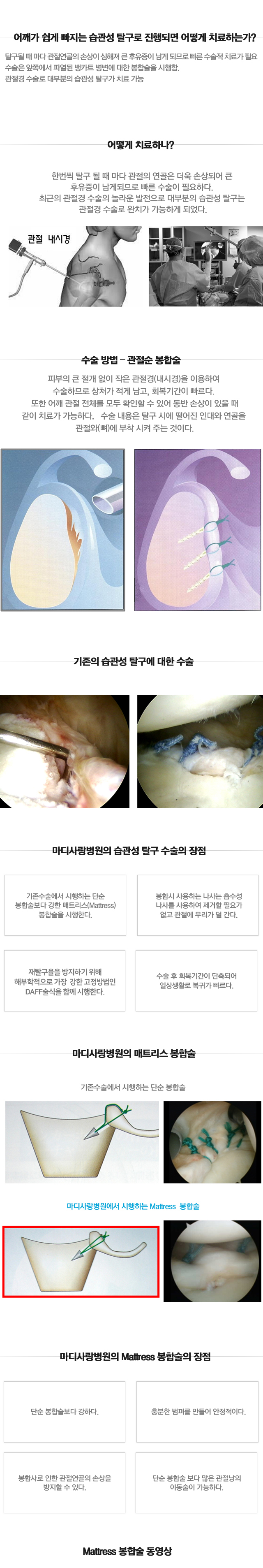 습관성 탈구
