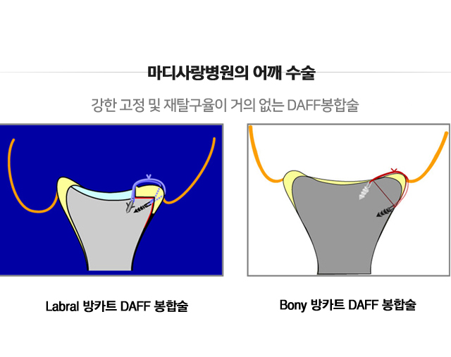 습관성 탈구