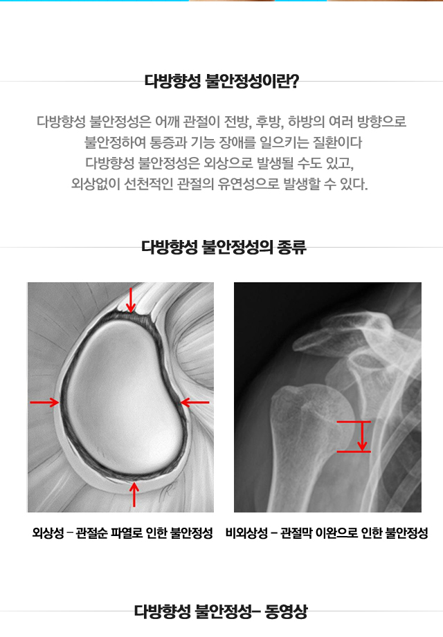 불안정성