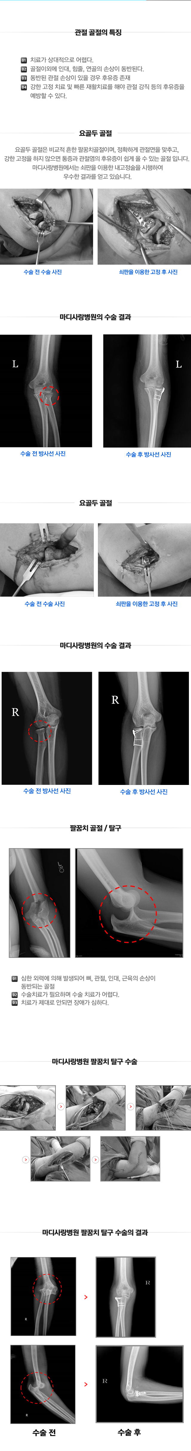 팔꿈치골절