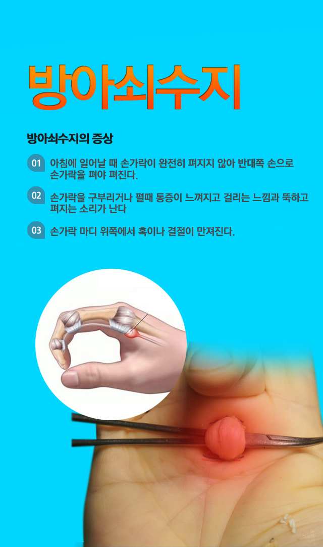방아쇠 수지