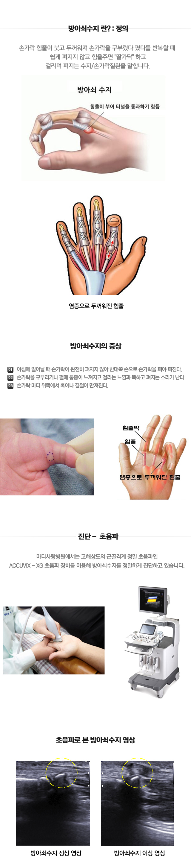 방아쇠 수지