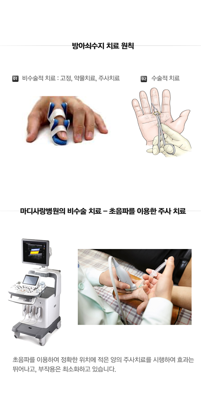 방아쇠 수지
