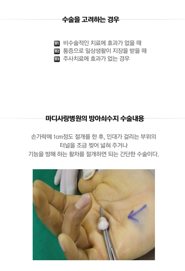 방아쇠 수지