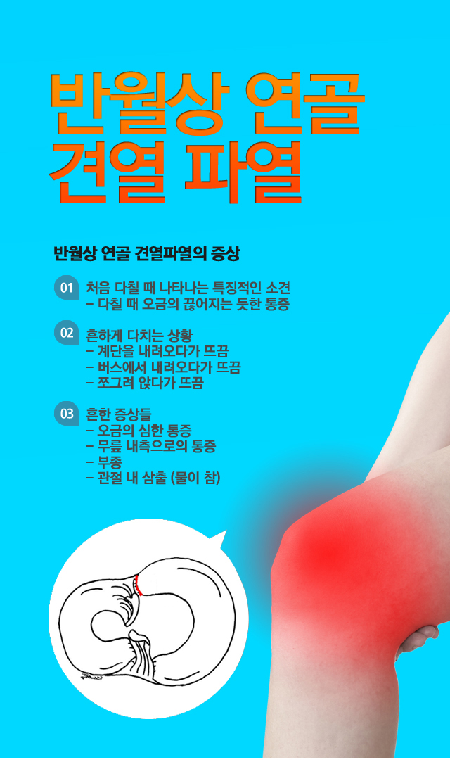 반월상연골 건열파열