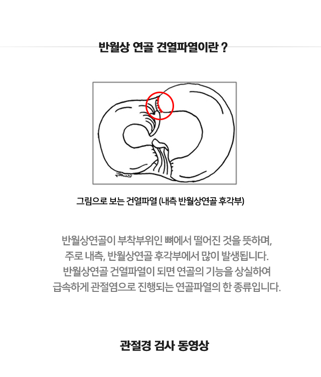 반월상연골 건열파열