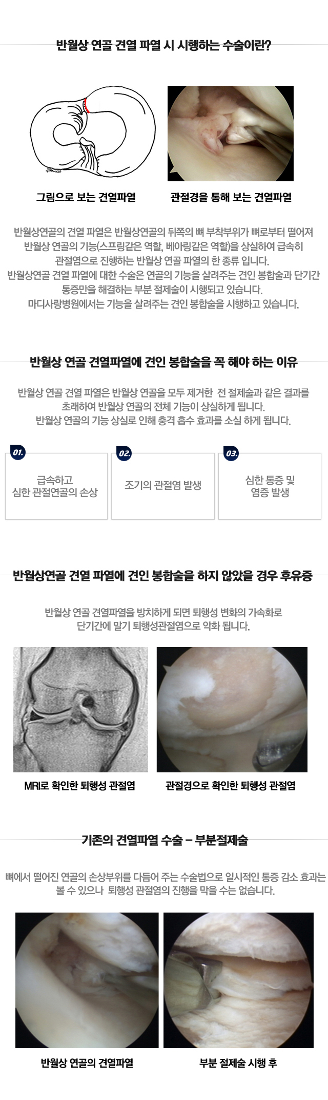 반월상연골 건열파열