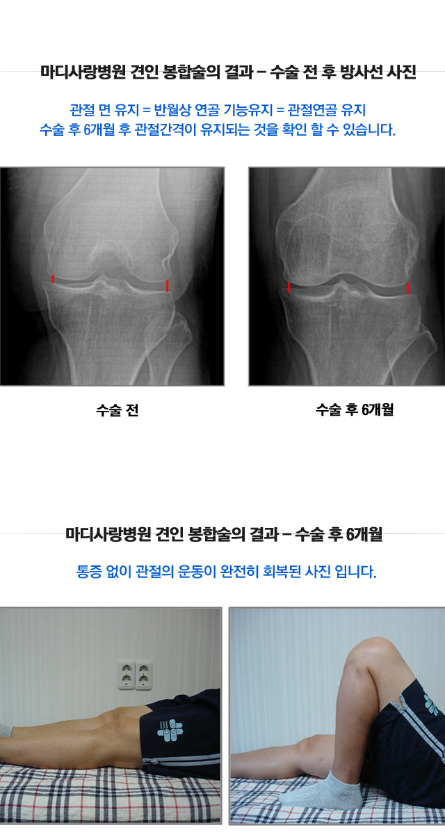 반월상연골 건열파열