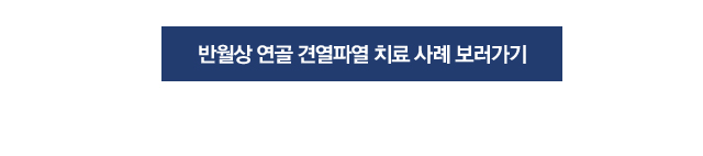 반월상연골 건열파열