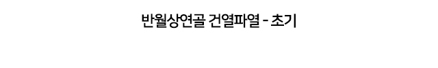반월상연골 건열파열