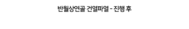 반월상연골 건열파열
