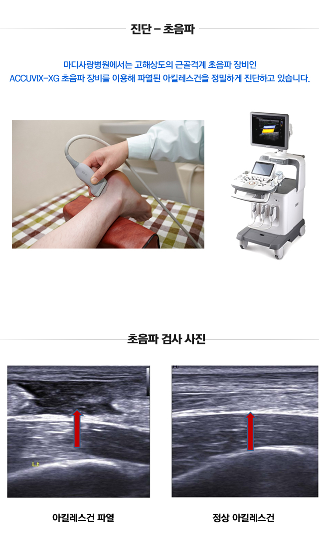 아킬레스건 손상 및 파열