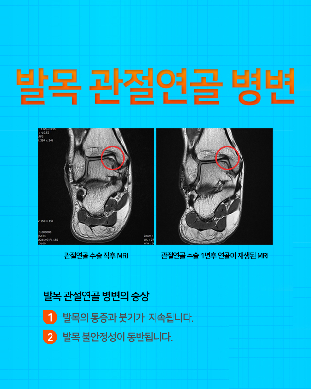 발목 관절연골 병변