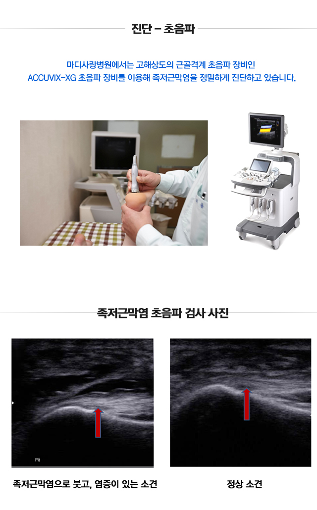 족저근막염