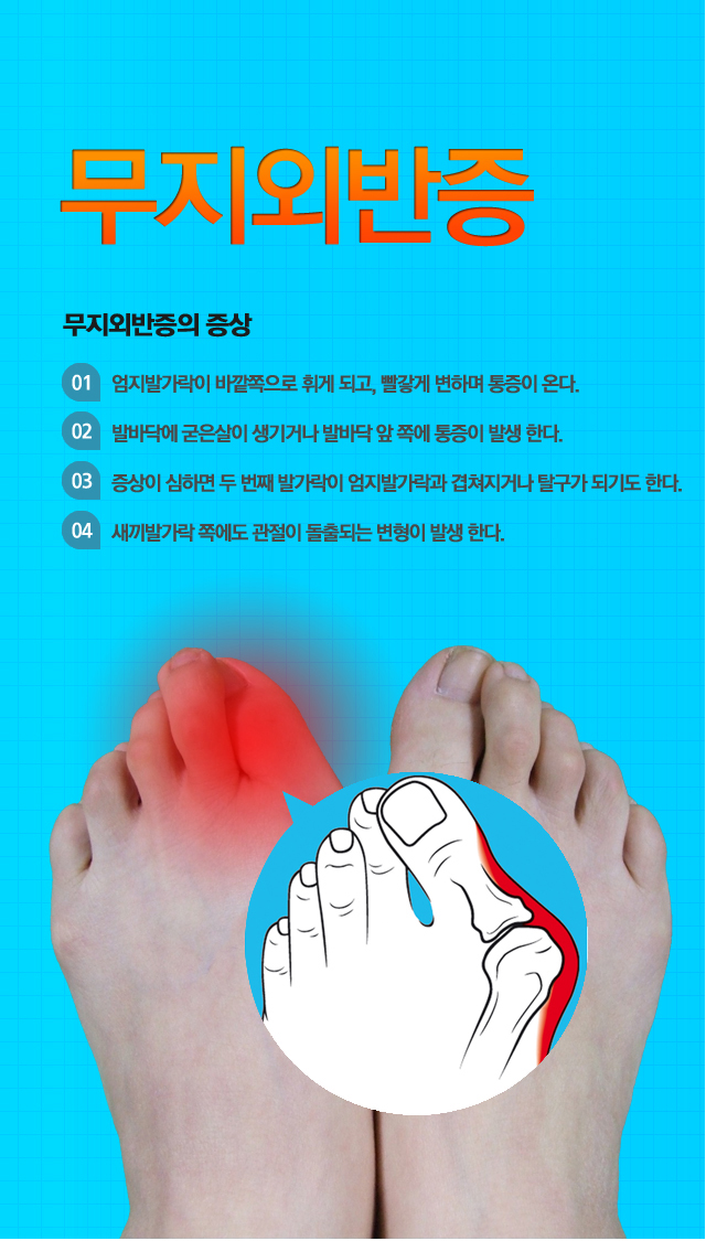 무지외반증