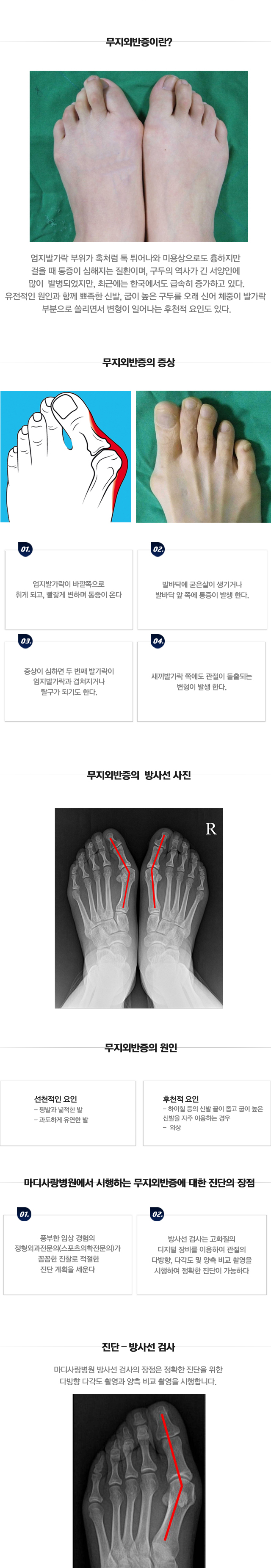 무지외반증