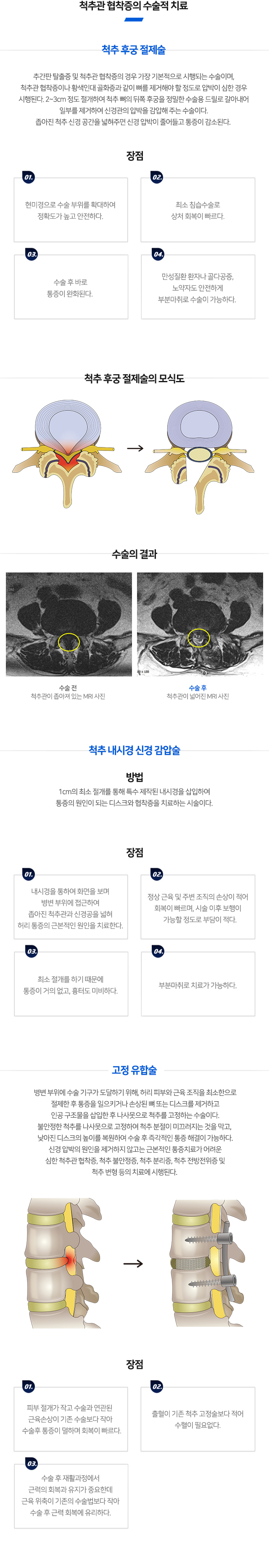 경추추간판탈출증