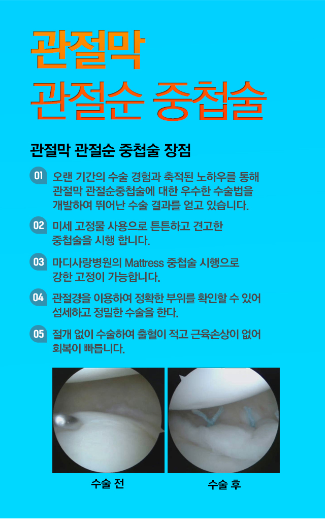 관절막 관절순 중첩술