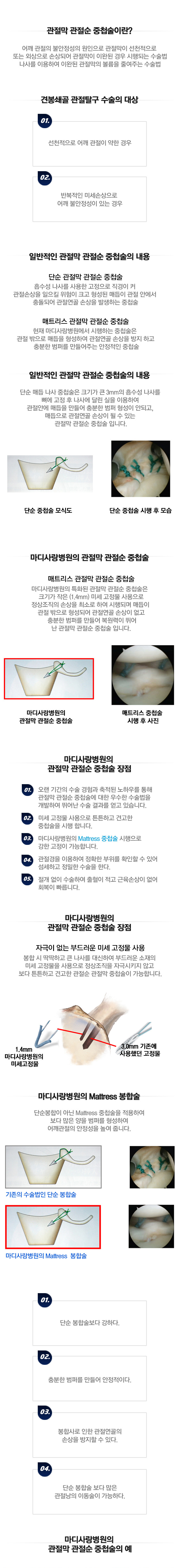관절막 관절순 중첩술