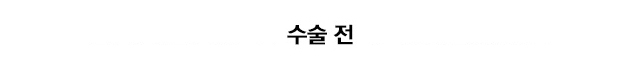 관절막 관절순 중첩술