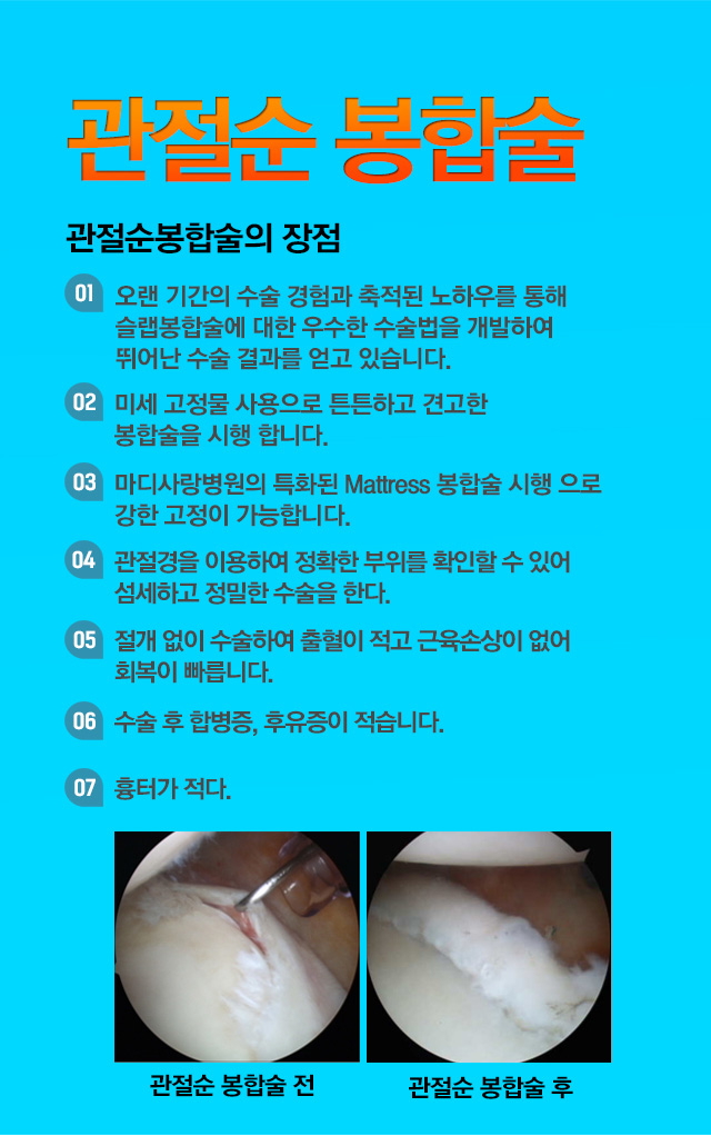 관절순 봉합술