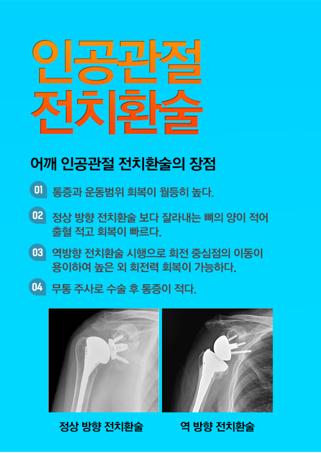 어깨 인공관절 전치환술