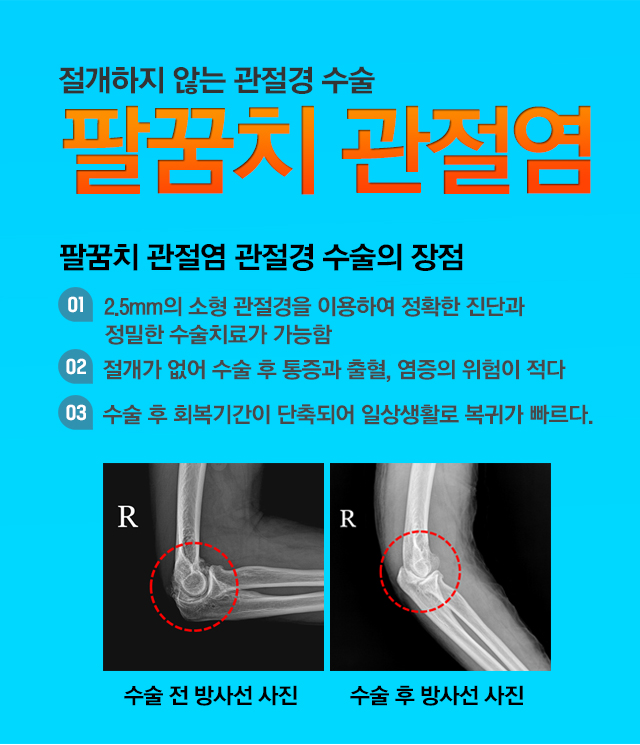 팔꿈치 관절염