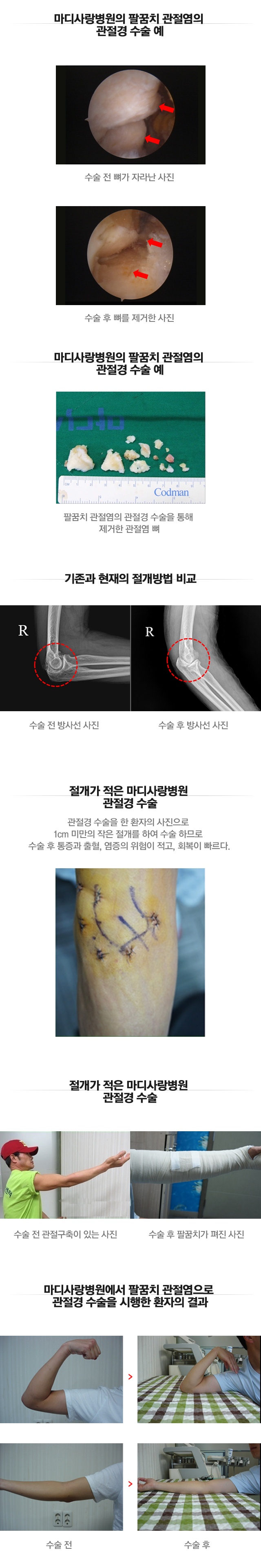 팔꿈치 관절염