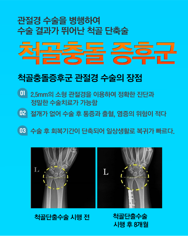 척골 충돌 증후군
