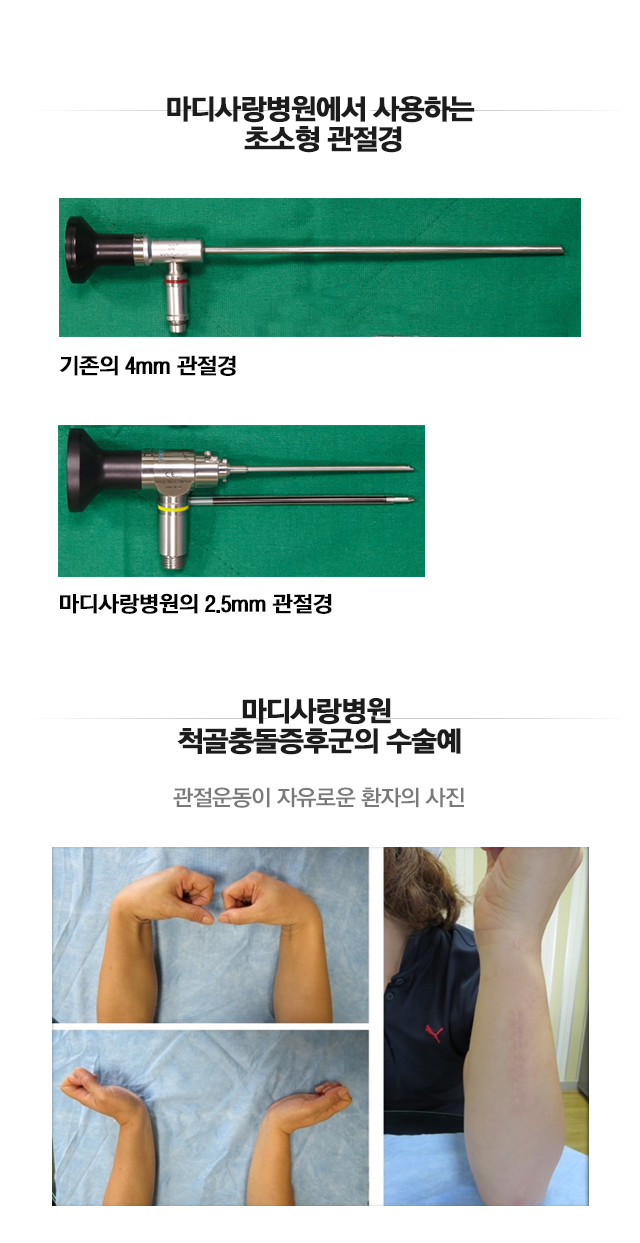 척골 충돌 증후군
