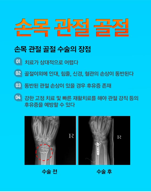 관절주위골절(손목)