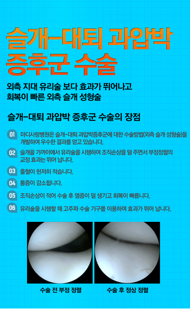 반월상연골 부분절제술