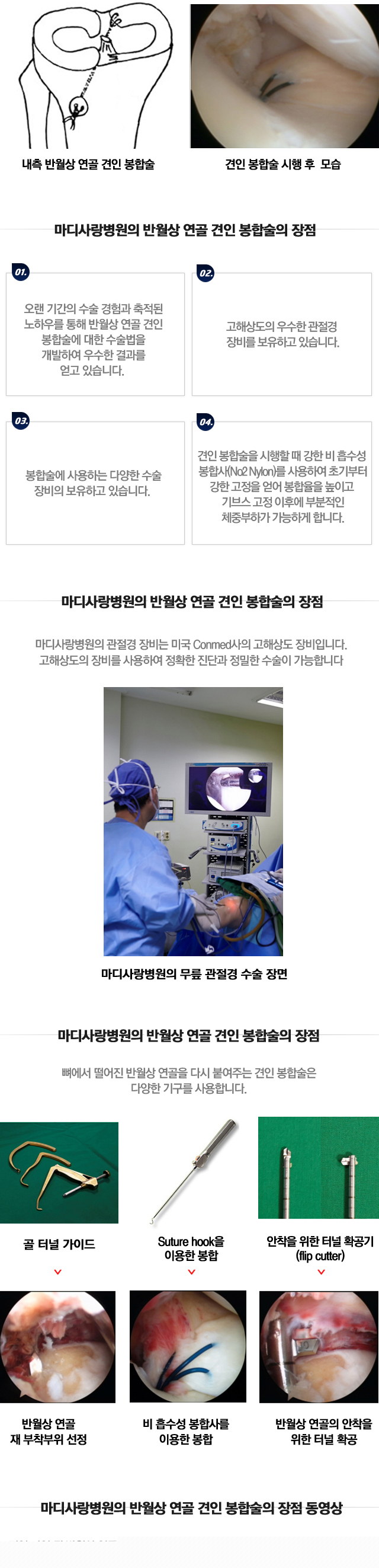 반월상연골 이식술