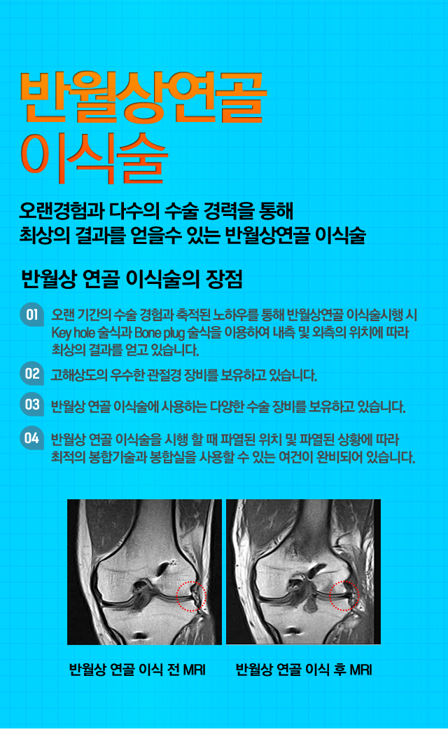 원판형 연골 파열수술