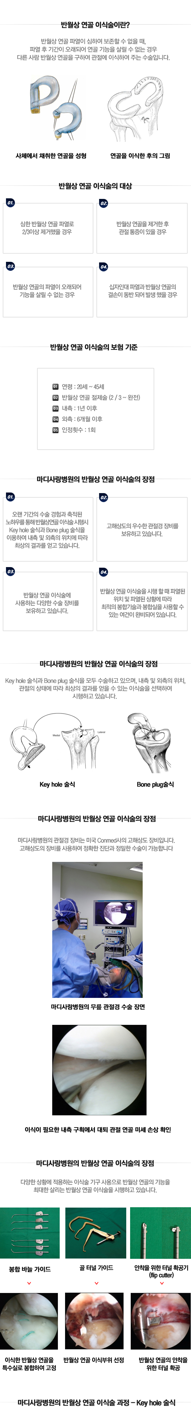 원판형 연골 파열수술