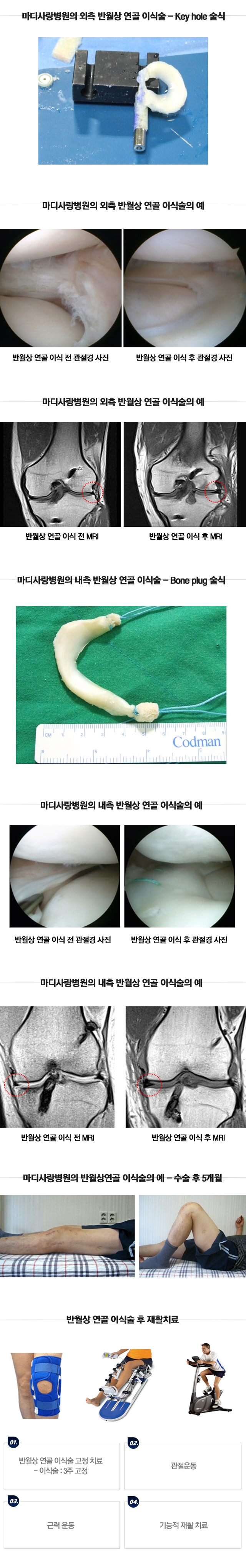 원판형 연골 파열수술